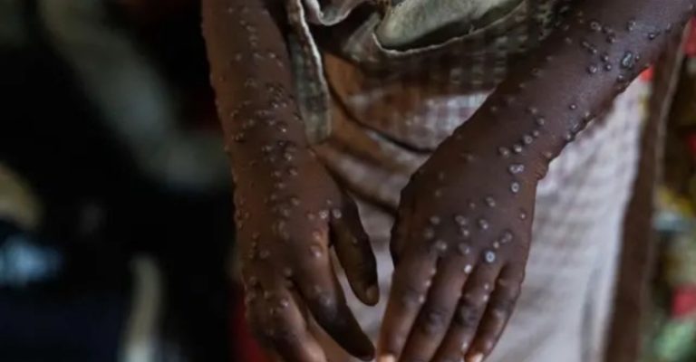 LE VACCIN CONTRE LE MPOX: LA VACCINATION DES ENFANTS.